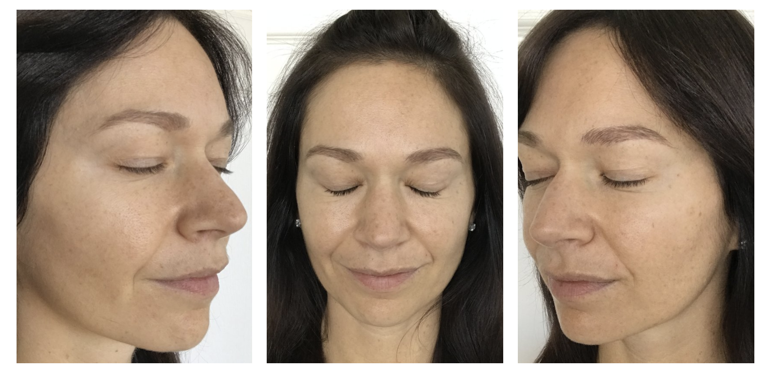 I Tried A Chemical Peel to Lighten My Hyperpigmentation