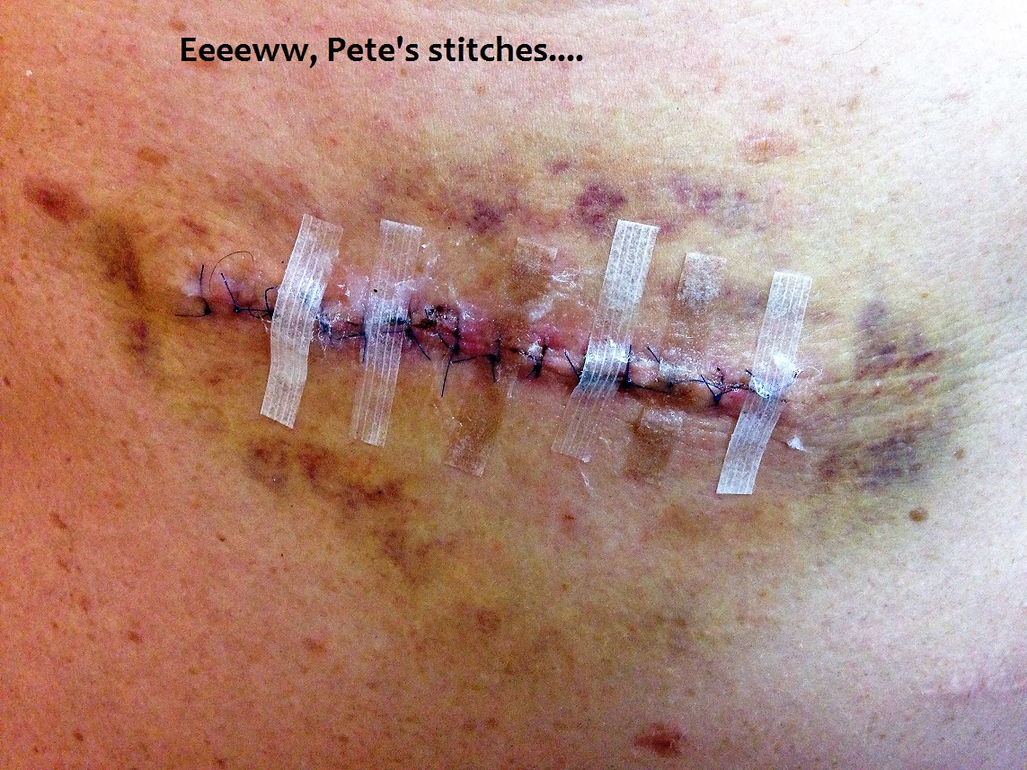 Eeeww stitches.JPG