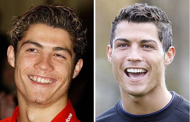 Smile Makeover 1 - Cristiano Ronaldo — Mint Dental