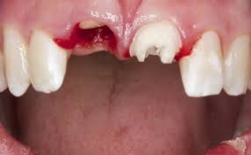 Broken Front Tooth and Intruded Front Tooth