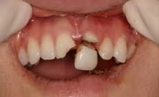 Hanging Tooth
