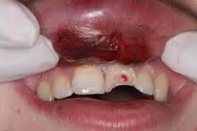 Soft Tissue damage and chipped tooth