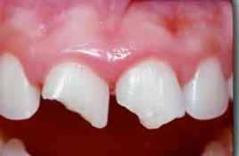 Broken From Teeth