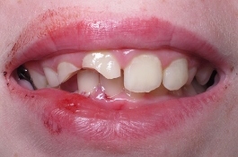 Broken Teeth and Soft Tissue Damage