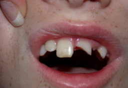 Broken From Tooth