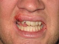 Lip and Teeth Damage