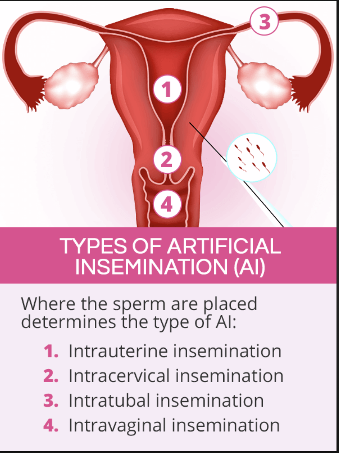 Artificial Insemination Need To Know Info Dr Lauren Streicher
