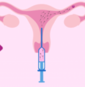 Injecting Sperm Into Vagina
