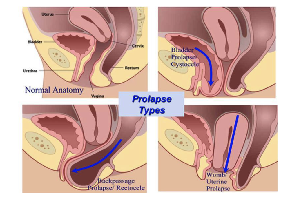 how to treat prolapse at home