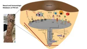 A New Era in Treating the Chronic Severe Itch of Prurigo Nodularis
