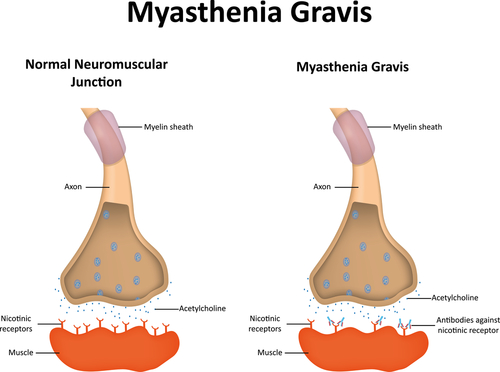 In Myasthenia Gravis, signals from the central nervous system to the muscles are blocked by antibodies. 