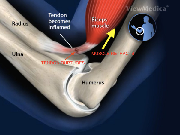 Overtraining the biceps: the muscles are shortened, pulling and straining the tendon that connects it the bone (radius). The tendon becomes inflamed, causing tendonitus.