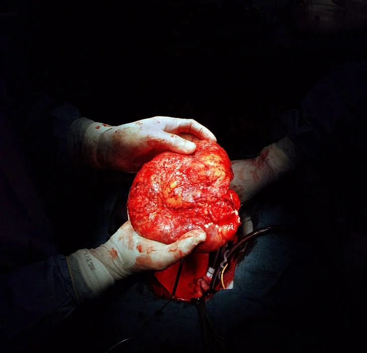 There are more than 50,000 people currently waiting on the United Network for Organ Sharing (UNOS) heart transplant list. Following are a few examples of the wait times of some of those people at New York City's Mt. Sinai hospital which I photographed for Life Magazine. 