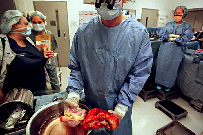 Joe's bad heart (at right) was enormously enlarged by the heart disease that also killed both his father and older brother. The harvested heart (at left), is what an average, healthy heart looks like.