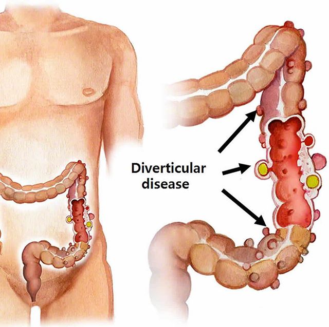 Learn the New Nutritional Intervention guidelines to prevent and alleviate the lower left abdomen intermittent discomfort associated with diverticulosis. 27% of the population have diverticulosis with possible symptoms of abdominal pain, bloating, c
