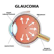 Glaucoma diagram.jpg