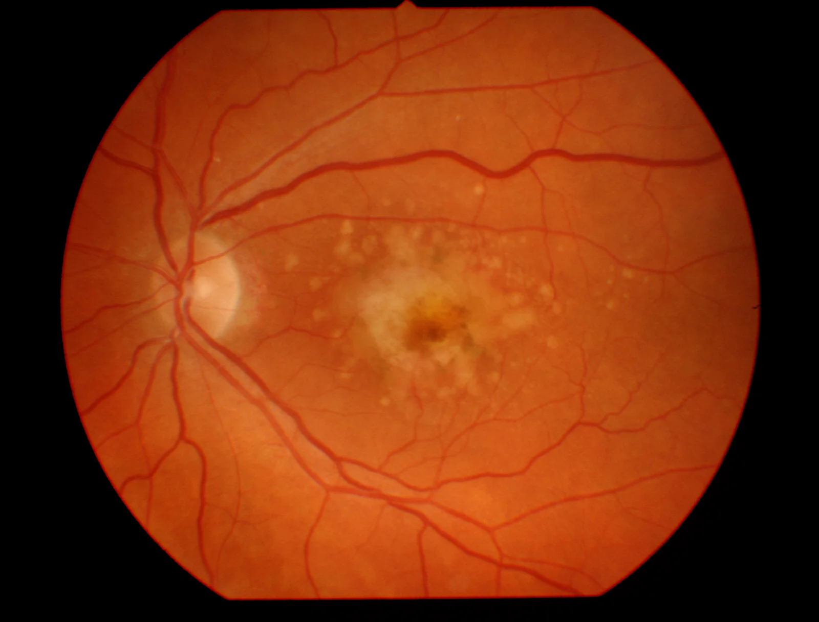 A Digital Retinal Image of Macular Degeneration