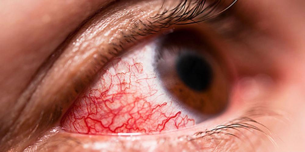 foretage ignorere Male Midtown Optometry - Red Eyes And How To Treat Them