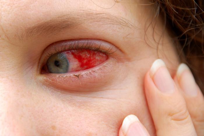 red sclera.jpg