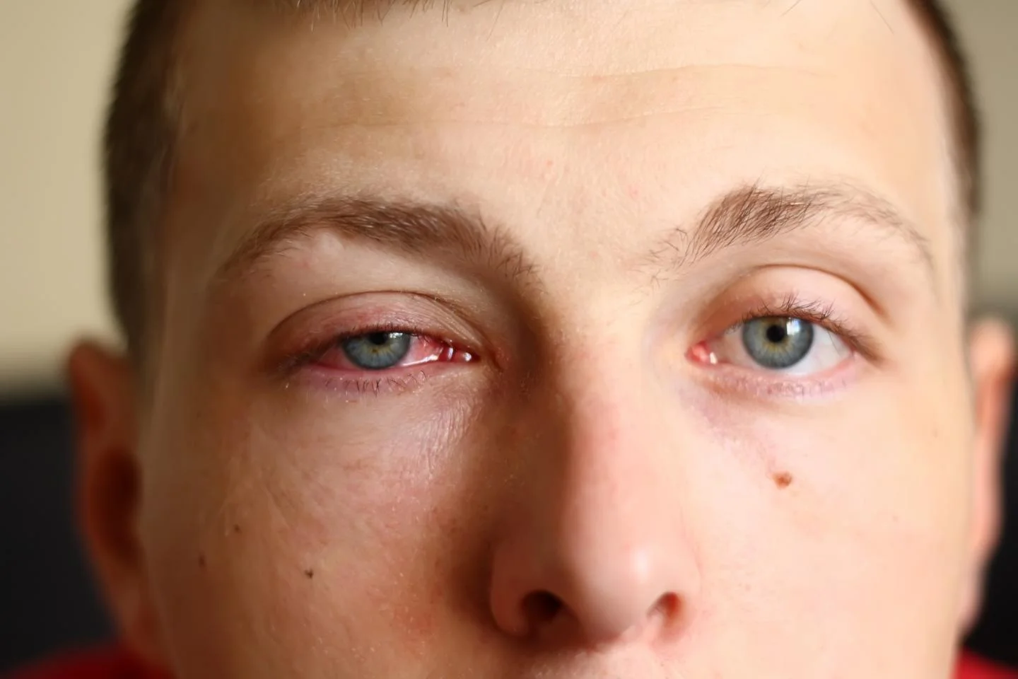 An example of viral conjunctivitis