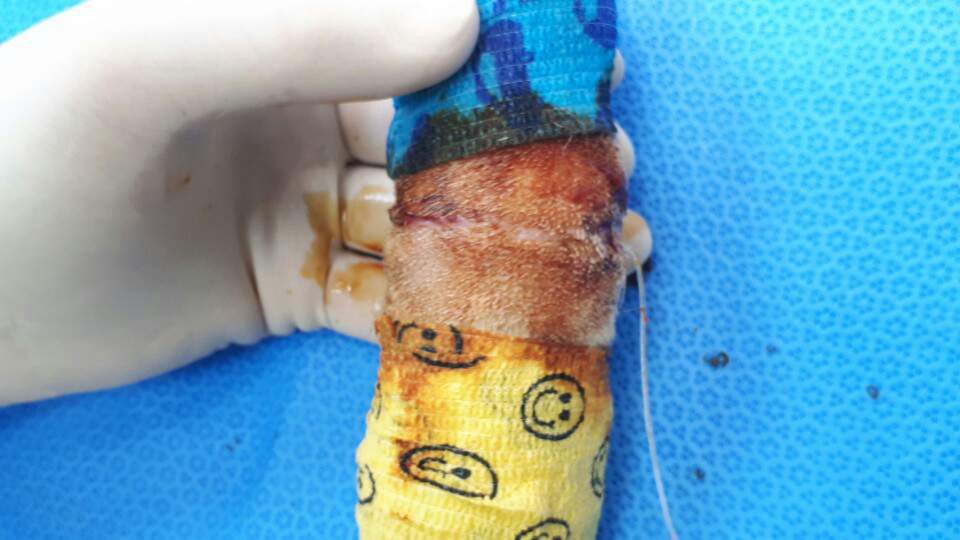 Louis' surgery (cut by string)