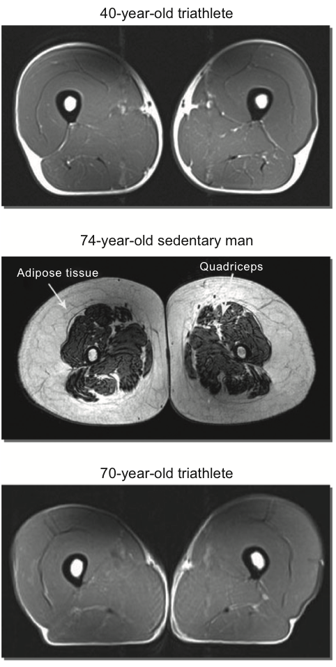 MRI showing thigh muscle mass Wroblewski et al (2011).