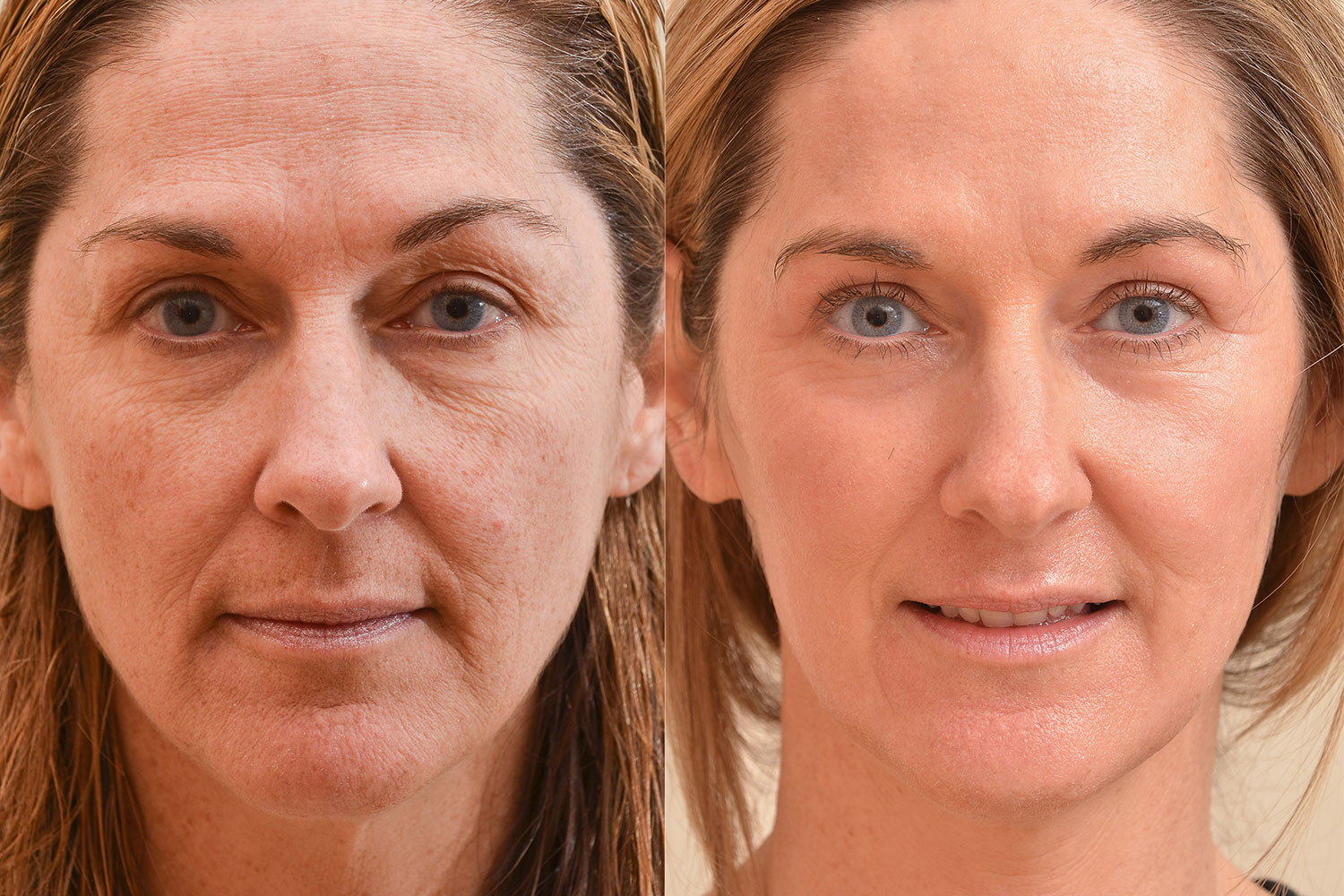 animación Gigante escena Laser Resurfacing - An Infinitely Customizable Way to Improve your Skin —  Tahoe Aesthetic Medicine