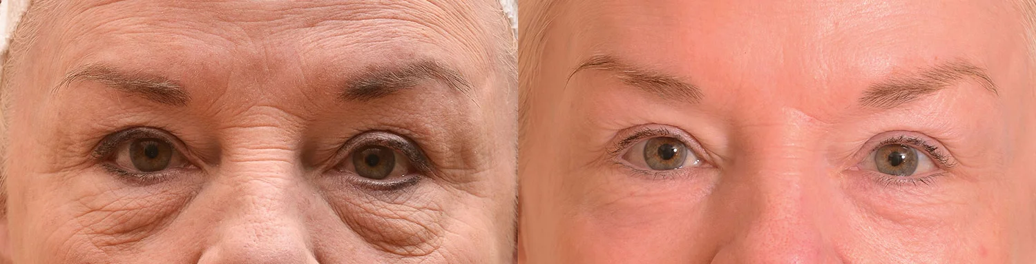 treatment for crow's feet