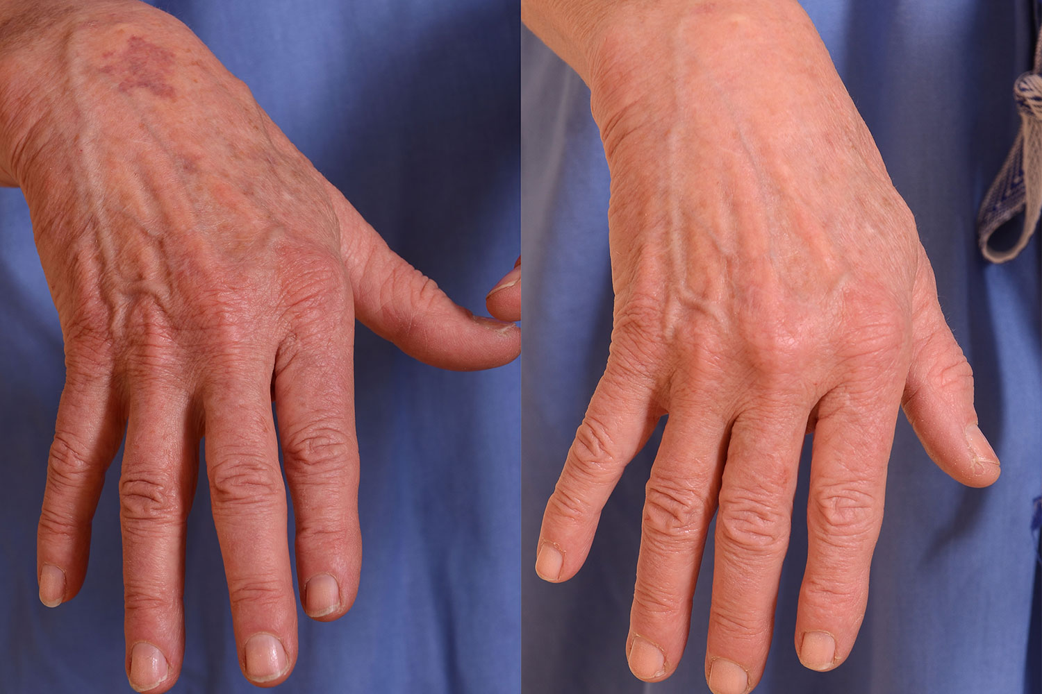 Hand-skin-Improvement-Before-and-After-resized.jpg