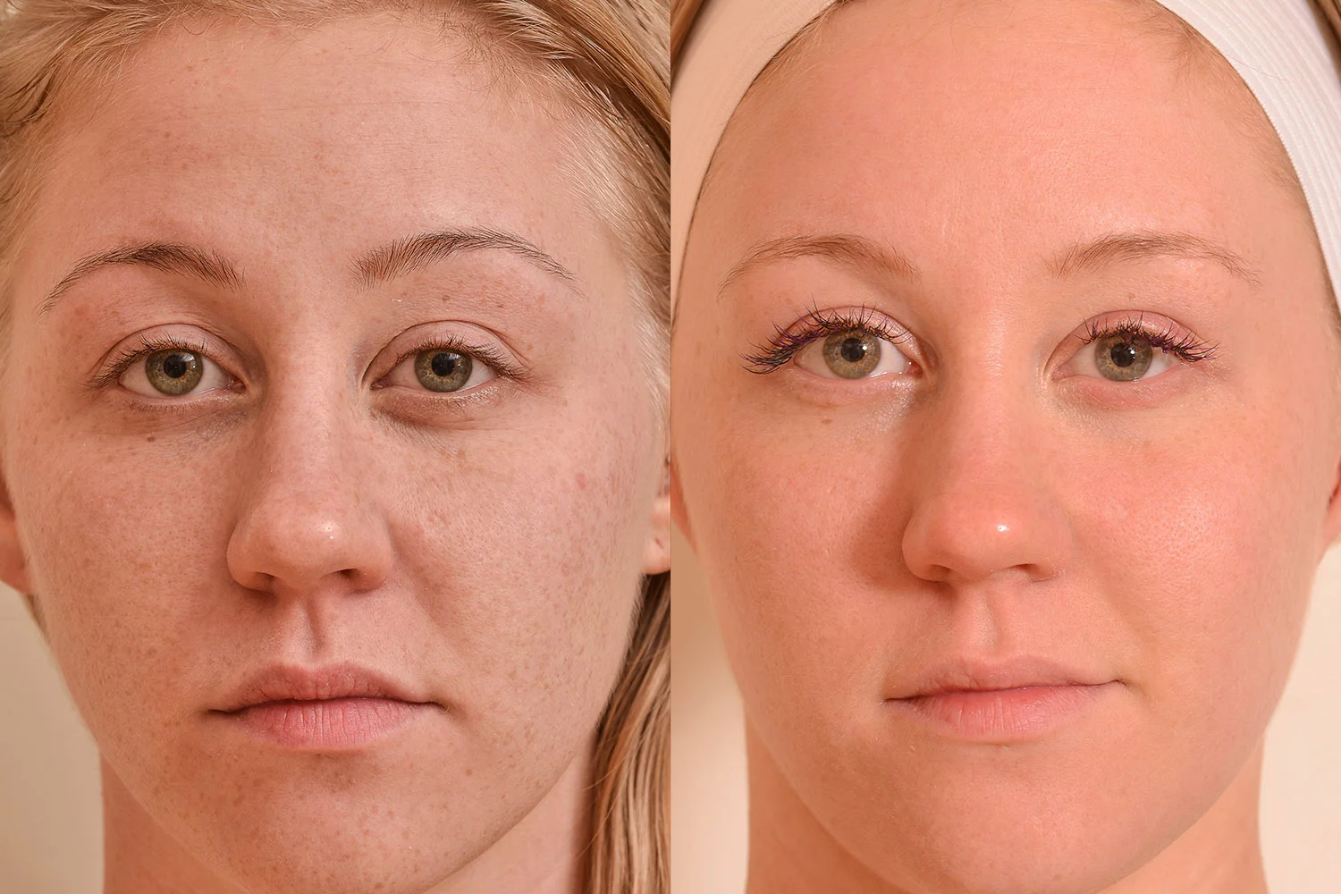 laser treatment for sun damage near me