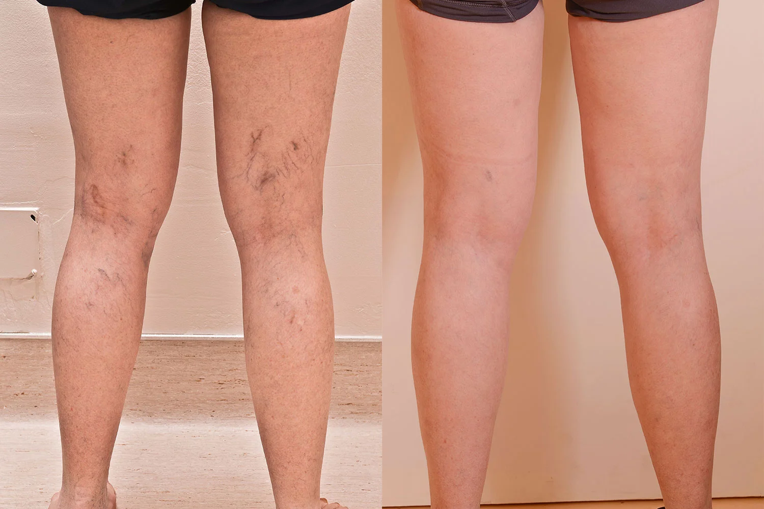 Leg-Vein-Treatment-.jpg