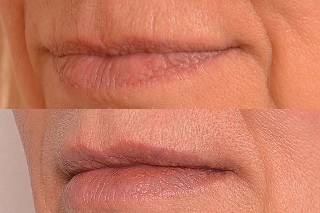 Reshaping lips.jpg