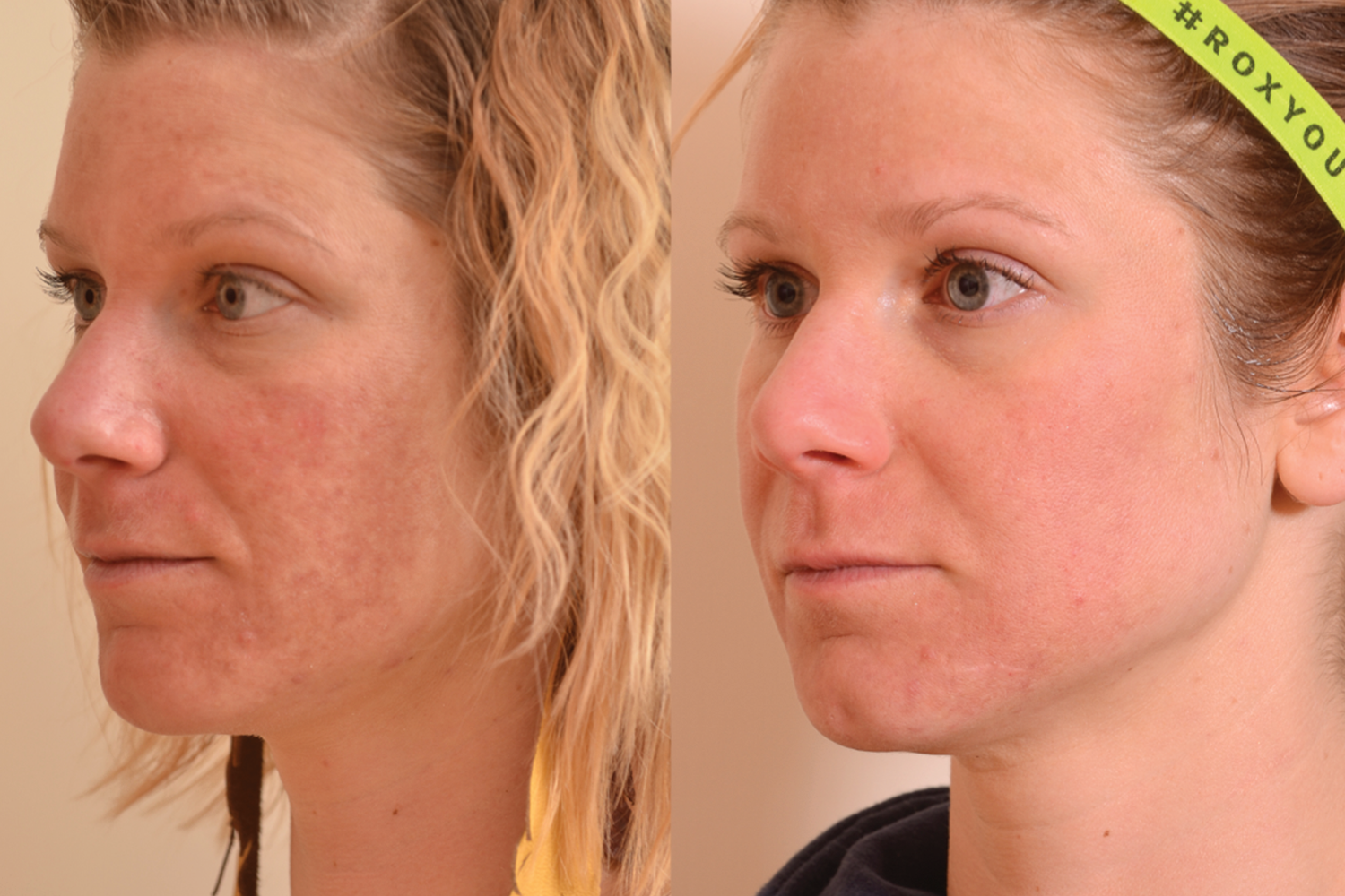 Melasma Side View.png