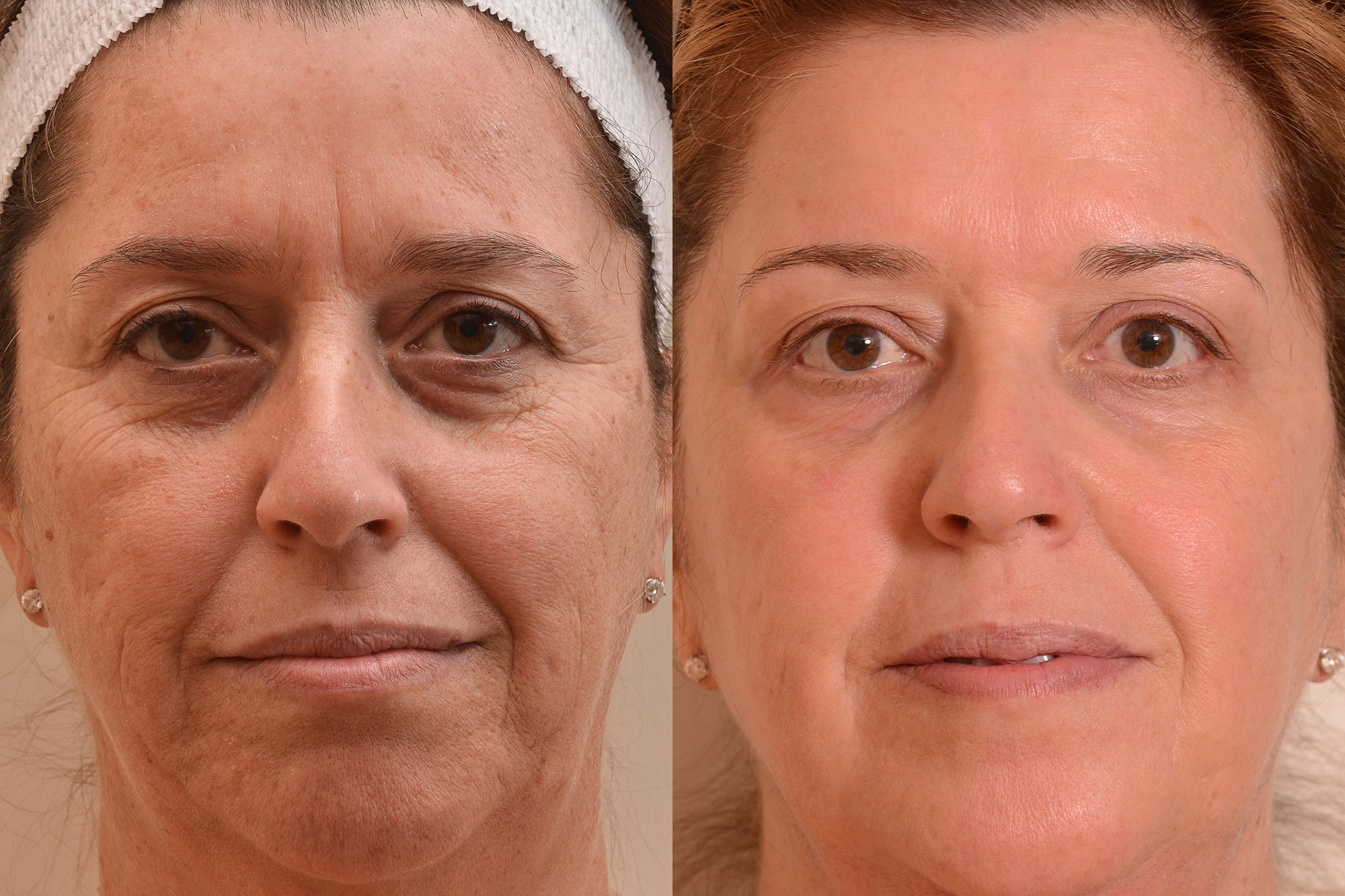 Rf лифтинг результаты. ДМАЕ вокруг глаз мезотерапия. Омоложение лица до и после. Лифтинг лица. Морщины до после.