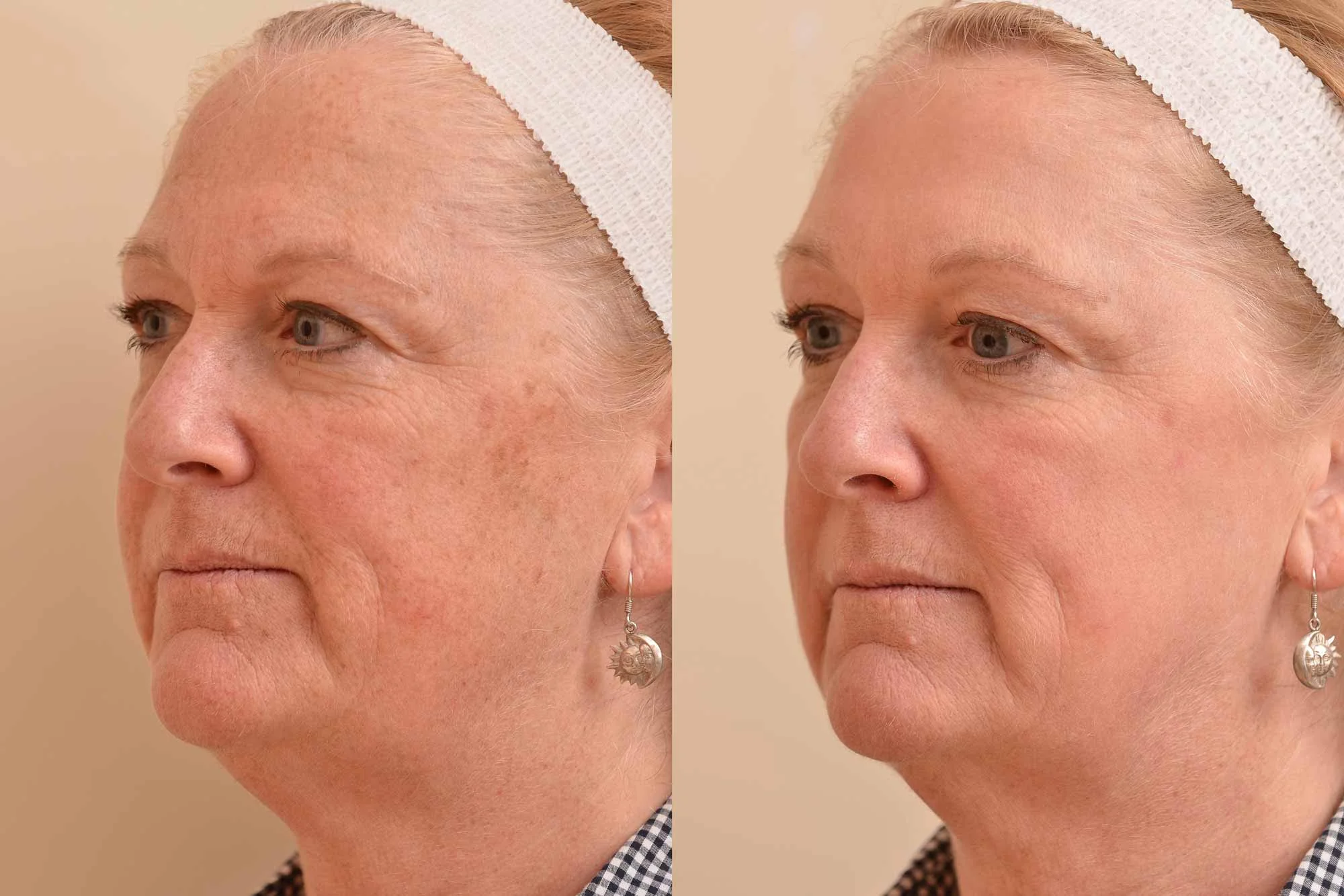 Combining BBL/Laser or Series of BBL for Sun Damage