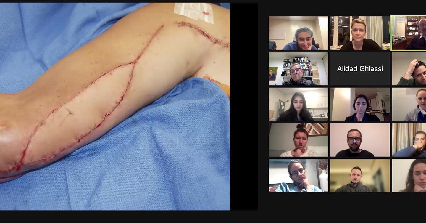 Great interdisciplinary conference last night with Orthopedic Surgery discussing complex limb salvage of the upper extremity, with flap pearls from world-renowned hand surgeon Dr Milan Stevanovic. We have a monthly hand conference in conjunction with