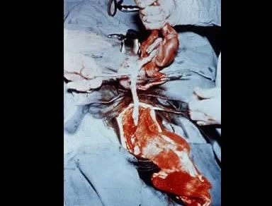 Hysterotomy Abortion: 4 to 9 months of pregnancy