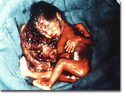 Salt Poisoning (Saline Amniocentesis): After 4 months of pregnancy