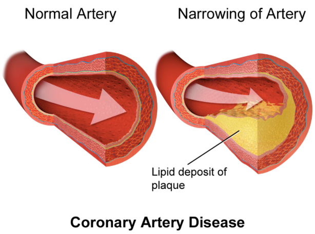 coronary_artery_atherosclerosis_-_Google_Search.png