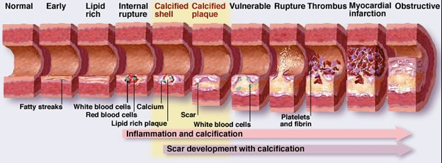coronary_artery_disease_-_Google_Search.png