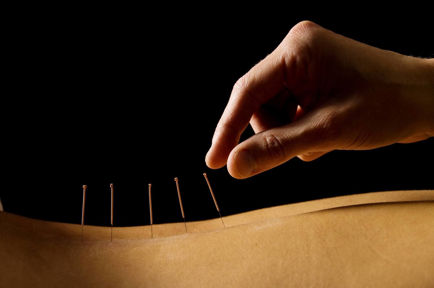 Dry Needling and Chiropractic Care in Herndon, Sterling and Northern, VA