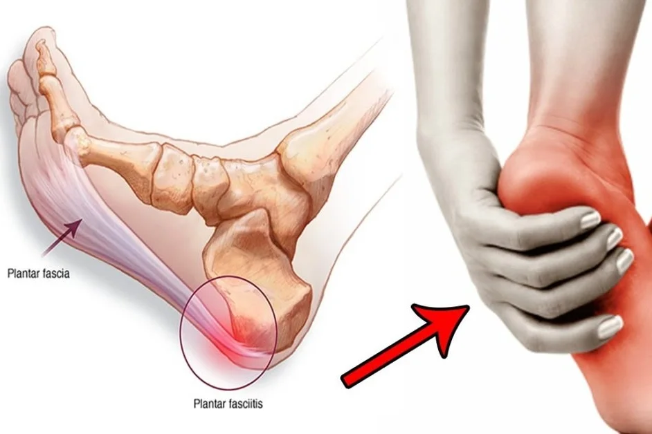 Plantar-Fasciitis-1170x628_c.jpg