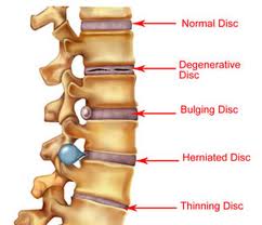 Key Differences Between a Herniated and Bulging Disc a sufferer in