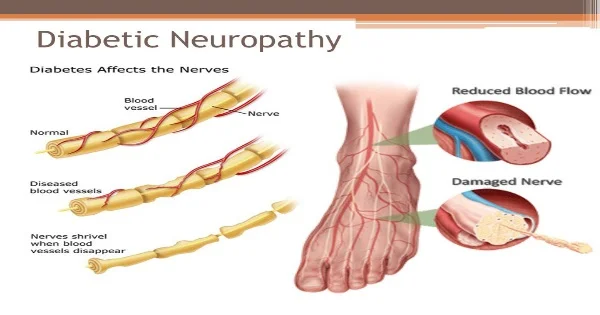 diabeticneuropathy.jpg