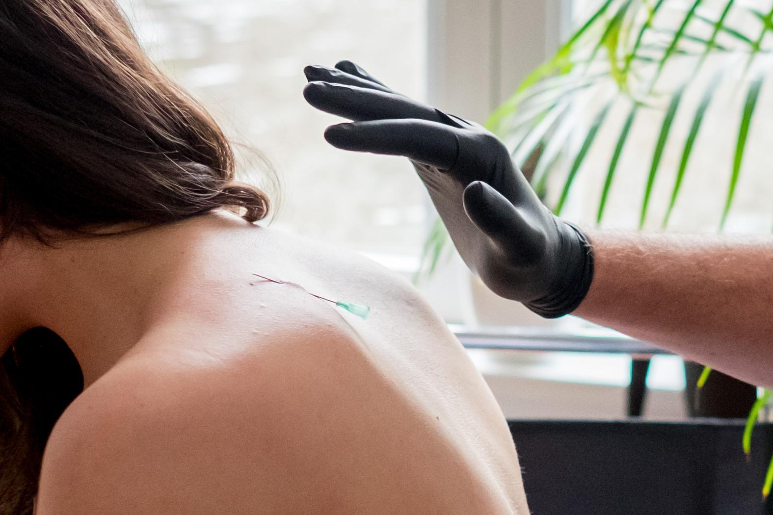 The needle, safely inserted into my back.