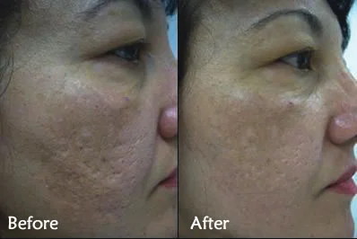 ENERPEEL PYRUVIC BEFORE & AFTER 3 SESSIONS + PRESCRIPTION PRODUCTS + DERMA FNS NEEDLING X 4 SESSIONS