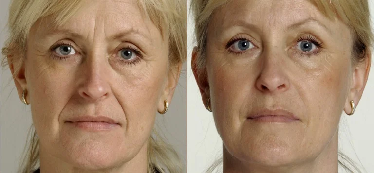 TSHAPE FACE LIFT, SKIN TIGHTENING RADIO FREQUENCY BEFORE & AFTER 6 SESSIONS