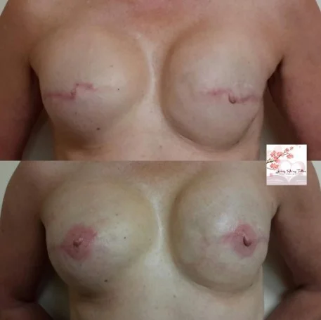 Bilateral Implant Based Tattoo
