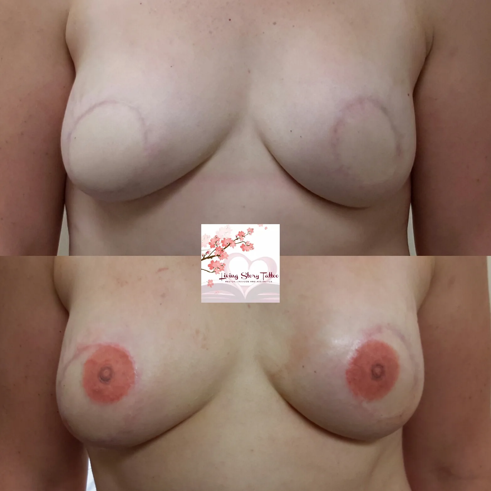 Bilateral DIEP Flap w/ 3D Nipple Tattoos