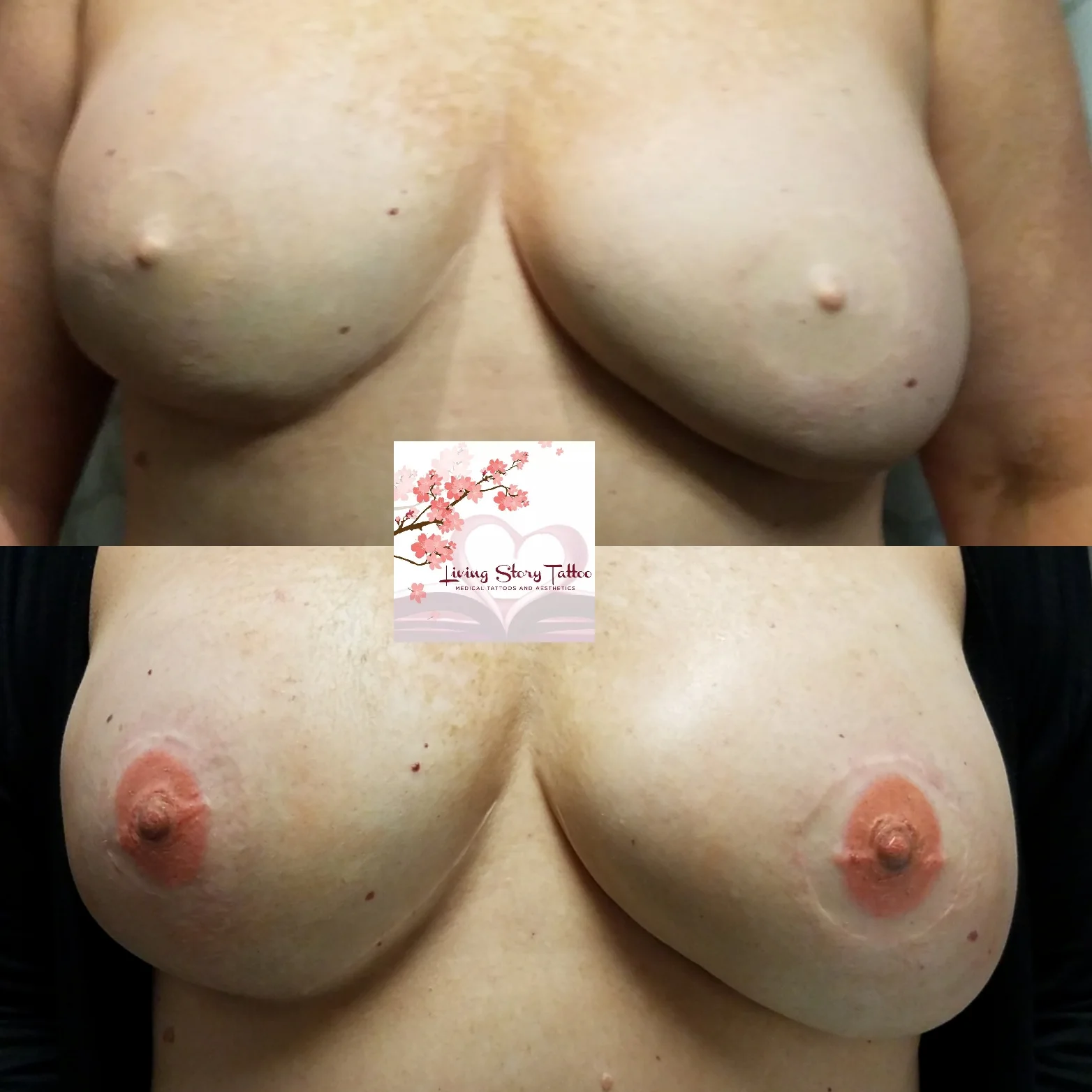 Bilateral DIEP Flap w/ Nipple Recon.
